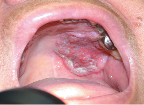 oral cancer