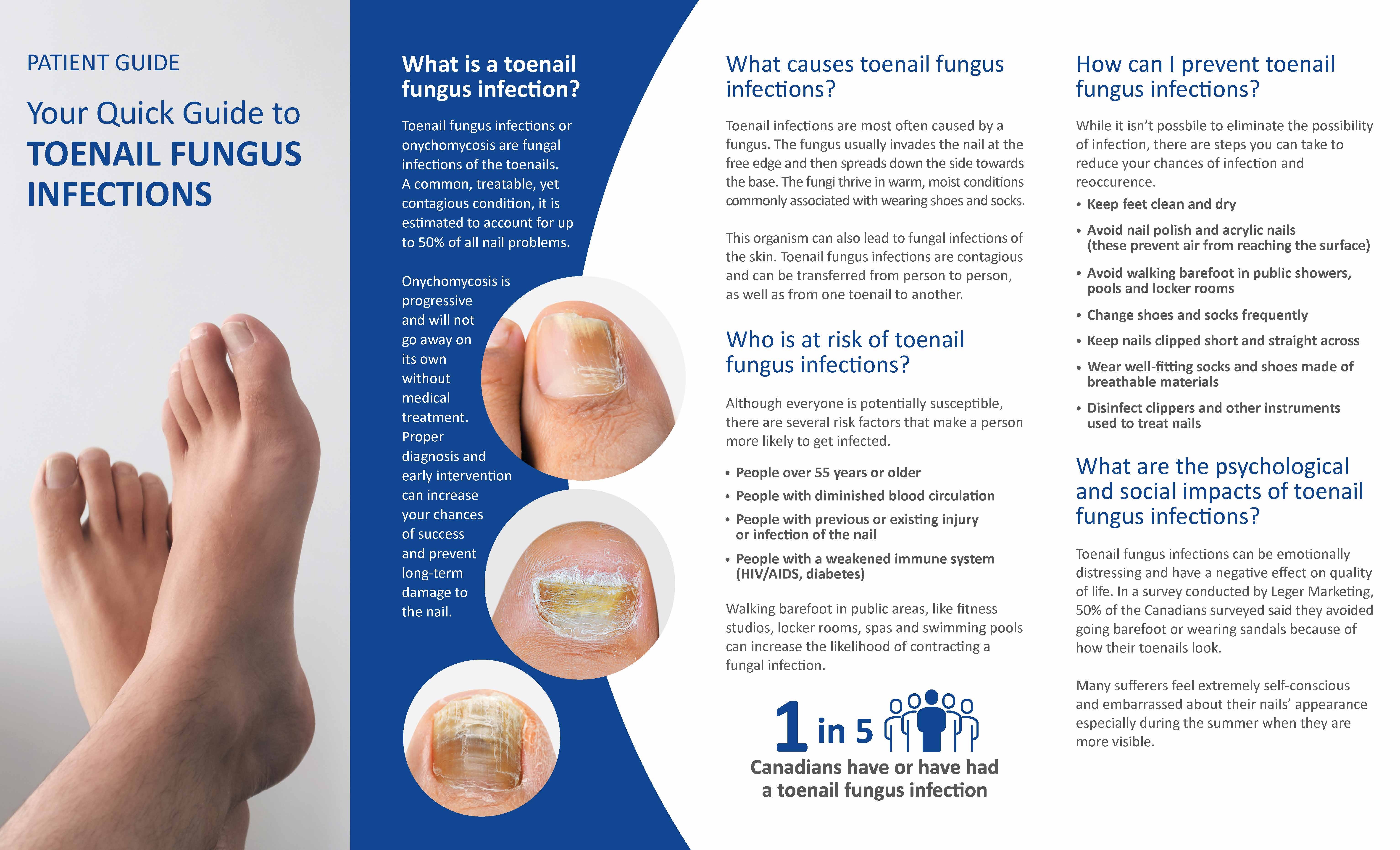 Patient leaflet web Toenail Fungus Infections Page 1