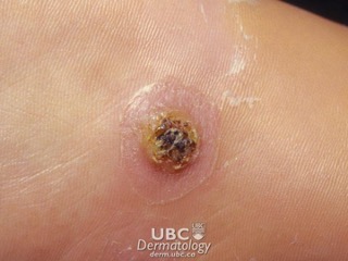 Common wart