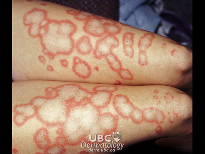 connective disease-1 lupus