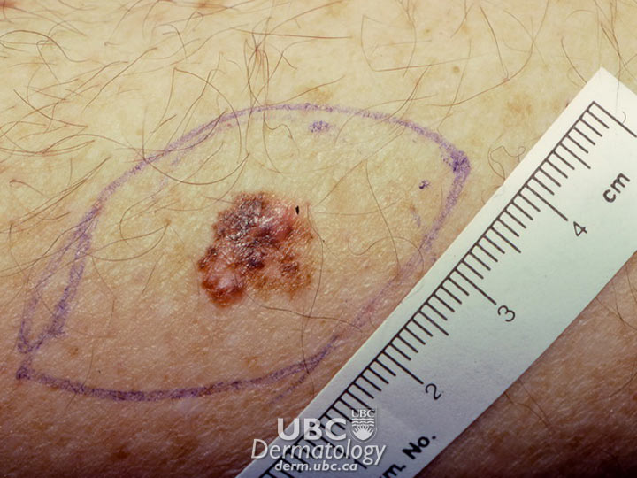 skincancer4-melanoma